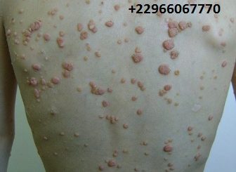 le molluscum contagiosum