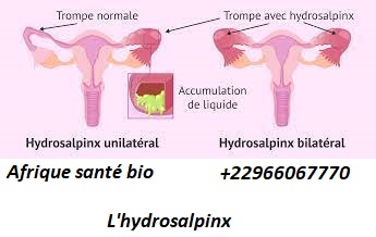 Savoir traiter l'hydrosalpinx naturellement