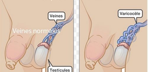Varicocèle Solution Naturelle Pour Guérir la Varicocèle Naturellement