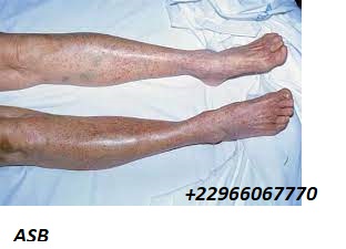 Causes et traitements de thrombocytopénie