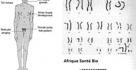 Syndrome de Klinefelter: Symptôme et Traitement Naturel