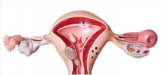 Comment enlever un fibrome avec plantes
