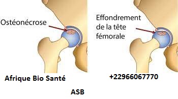 L'ostéonécrose: Causes, Symptômes et Traitement
