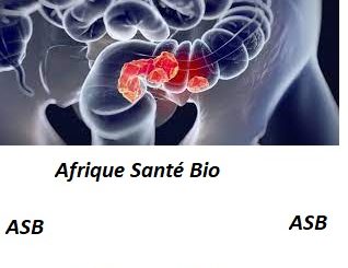 Solution Cancer de l'Intestin: Causes, Symptômes, Traitement Naturel
