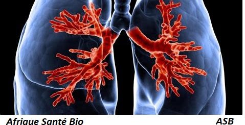 La mucoviscidose: Causes Symptômes et Traitement Naturel