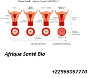 Cancer du col de l’utérus: Causes, symptômes et Traitement Naturel