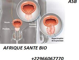 Hyperplasie prostatique bénigne