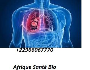 LA BPCO, QU’EST-CE QUE C’EST ?