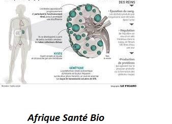 Soigne Le Cancer de la Prostate