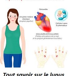 Tout savoir sur le lupus