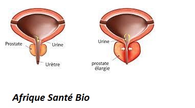 Soigner la prostatite