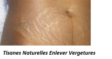 Tisanes Naturelles Enlever Vergetures
