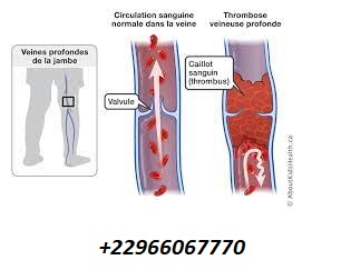 Thrombose veineuse