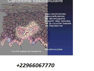 Quels sont les signes d'un carcinome ?