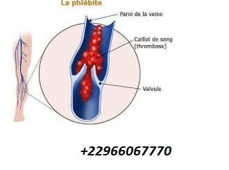 Mieux comprendre le mot thrombophlébite
