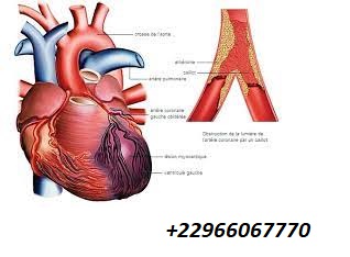 L’INFARCTUS DU MYOCARDE
