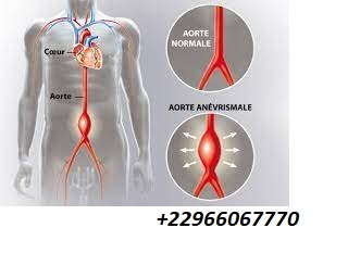Anévrisme de l'aorte abdominale