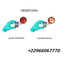 HÉMATURIE :QUELLES SONT LES CAUSES ?