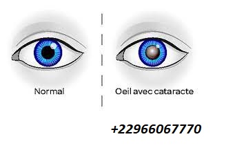 Traitement Cataracte