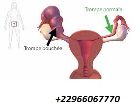Phimosis tubaire Causes