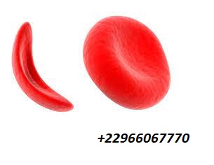 Drépanocytose Manifestations chroniques