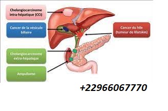Le Cholangiocarcinome: Symptômes Traitements
