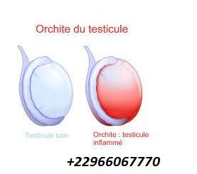 Comprendre l'orchi-épididymite ?