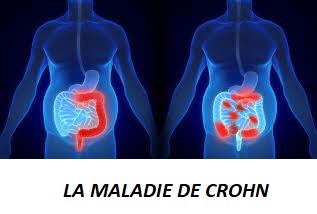 LA MALADIE DE CROHN