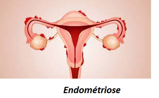 L’endométriose Définition